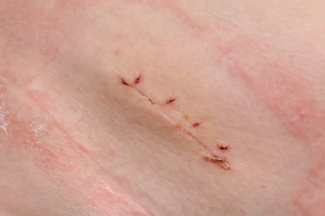 伤口凝胶敷料怎么用6常见伤口敷料有哪些，伤口敷料该怎么选？_https://www.jmylbn.com_新闻资讯_第2张