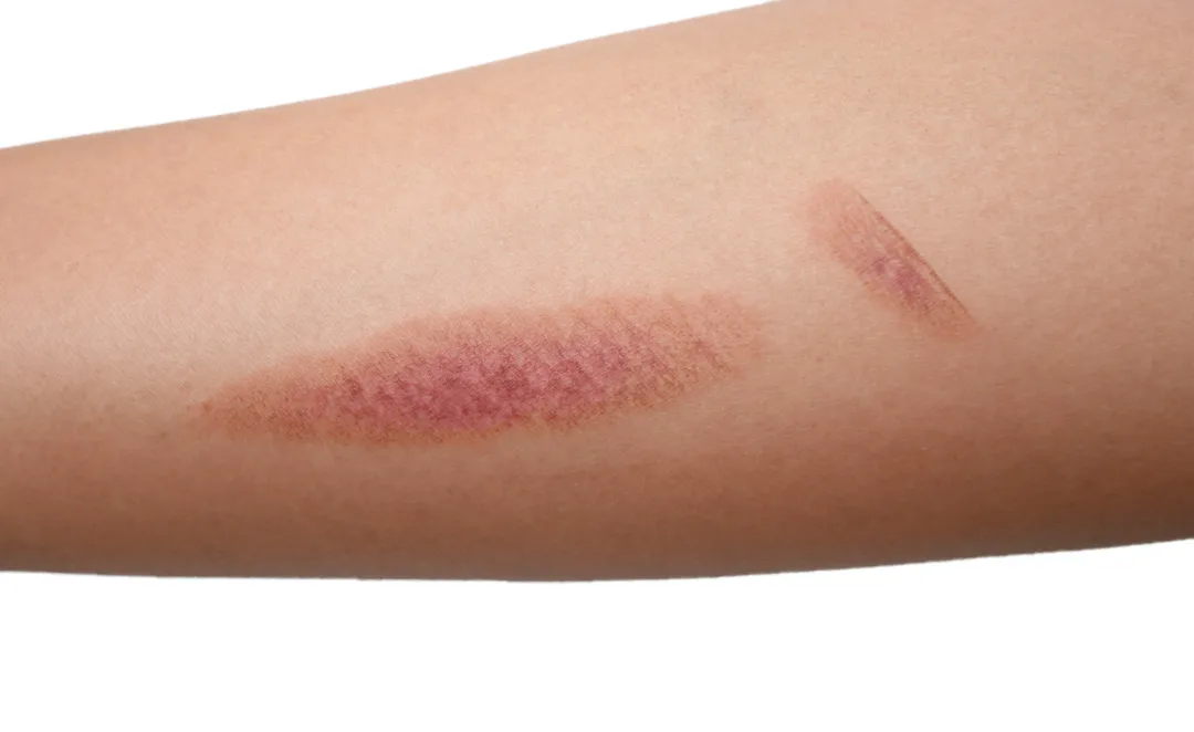 伤口凝胶敷料怎么用6常见伤口敷料有哪些，伤口敷料该怎么选？_https://www.jmylbn.com_新闻资讯_第3张